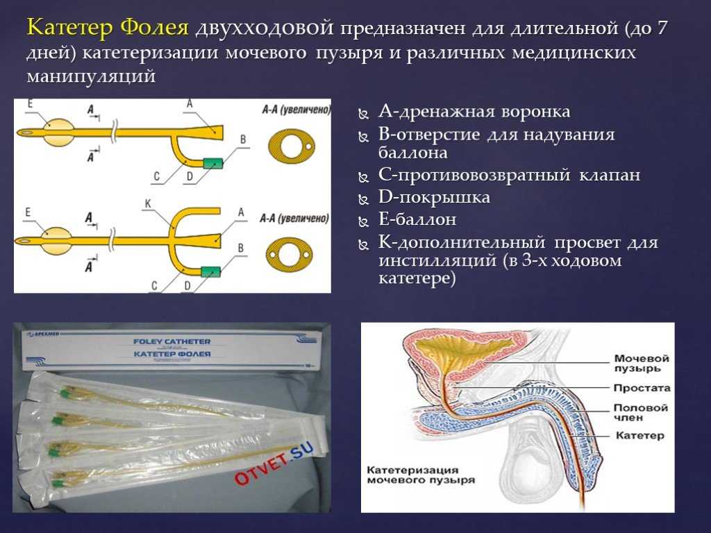 Виды катетеров для мочевого пузыря для женщин фото и описание